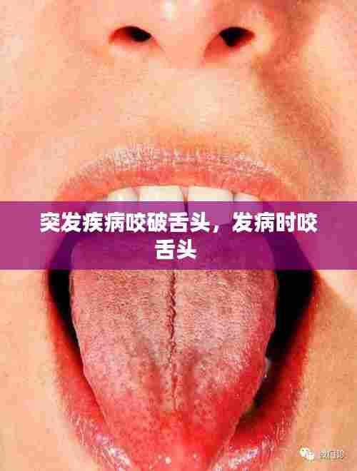 突发疾病咬破舌头,发病时咬舌头