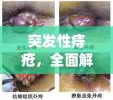 突发性痔疮,全面解析、预防与治疗策略